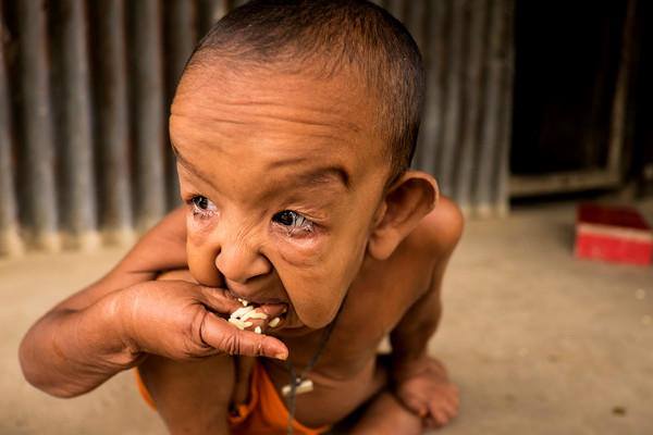 PHOTOS - This Bangladeshi Boy is Trapped in an Old Man's Body