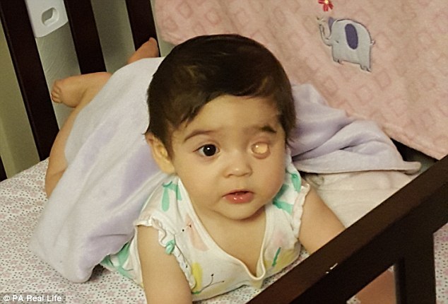 Baby Girl Born Without Eyeball Fitted With New Plastic Ball Every 2